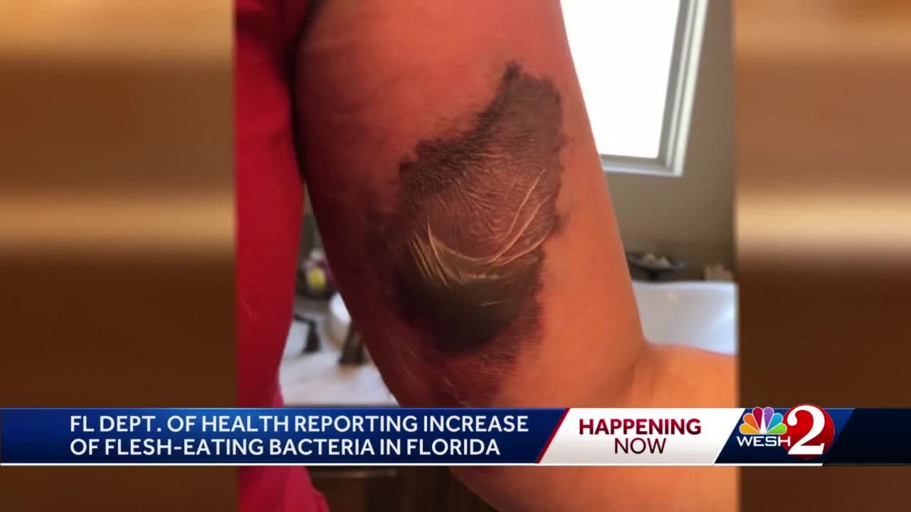 Flesh-eating bacteria spikes in Florida after Hurricane Ian